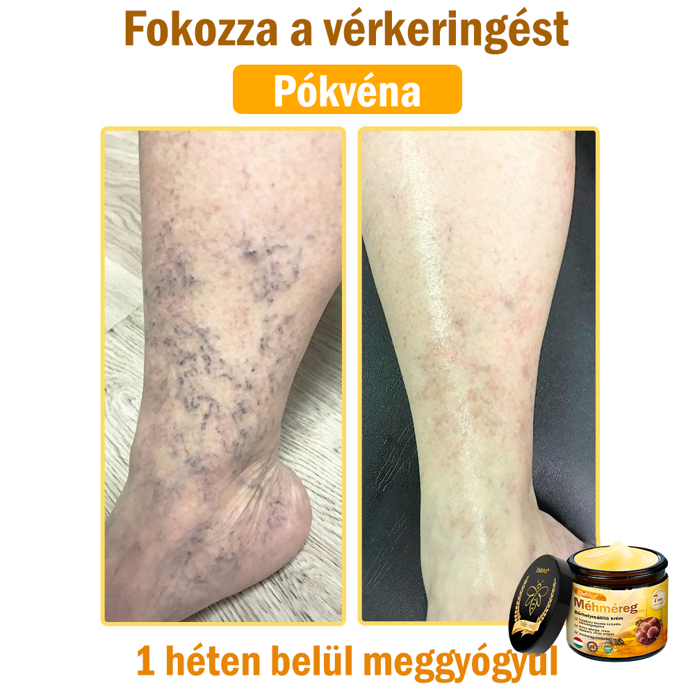 🌿Bőrgyógyász ajánlása💪ZödVita® Méhméreg Bőrhelyreállító Krém (👨⚕CE jóváhagyott)✅