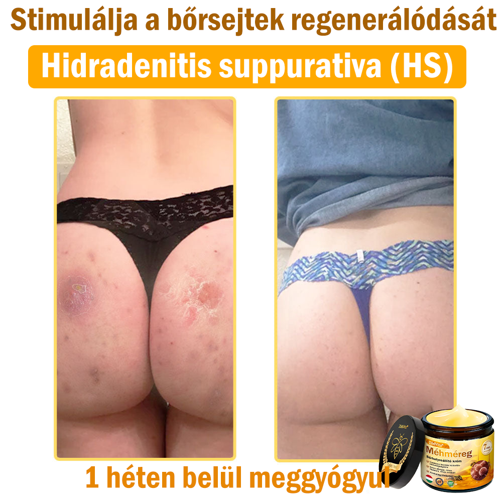 🌿Bőrgyógyász ajánlása💪ZödVita® Méhméreg Bőrhelyreállító Krém (👨⚕CE jóváhagyott)✅