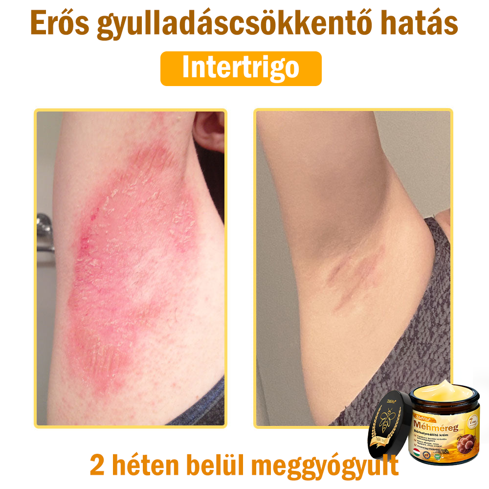 🌿Bőrgyógyász ajánlása💪ZödVita® Méhméreg Bőrhelyreállító Krém (👨⚕CE jóváhagyott)✅