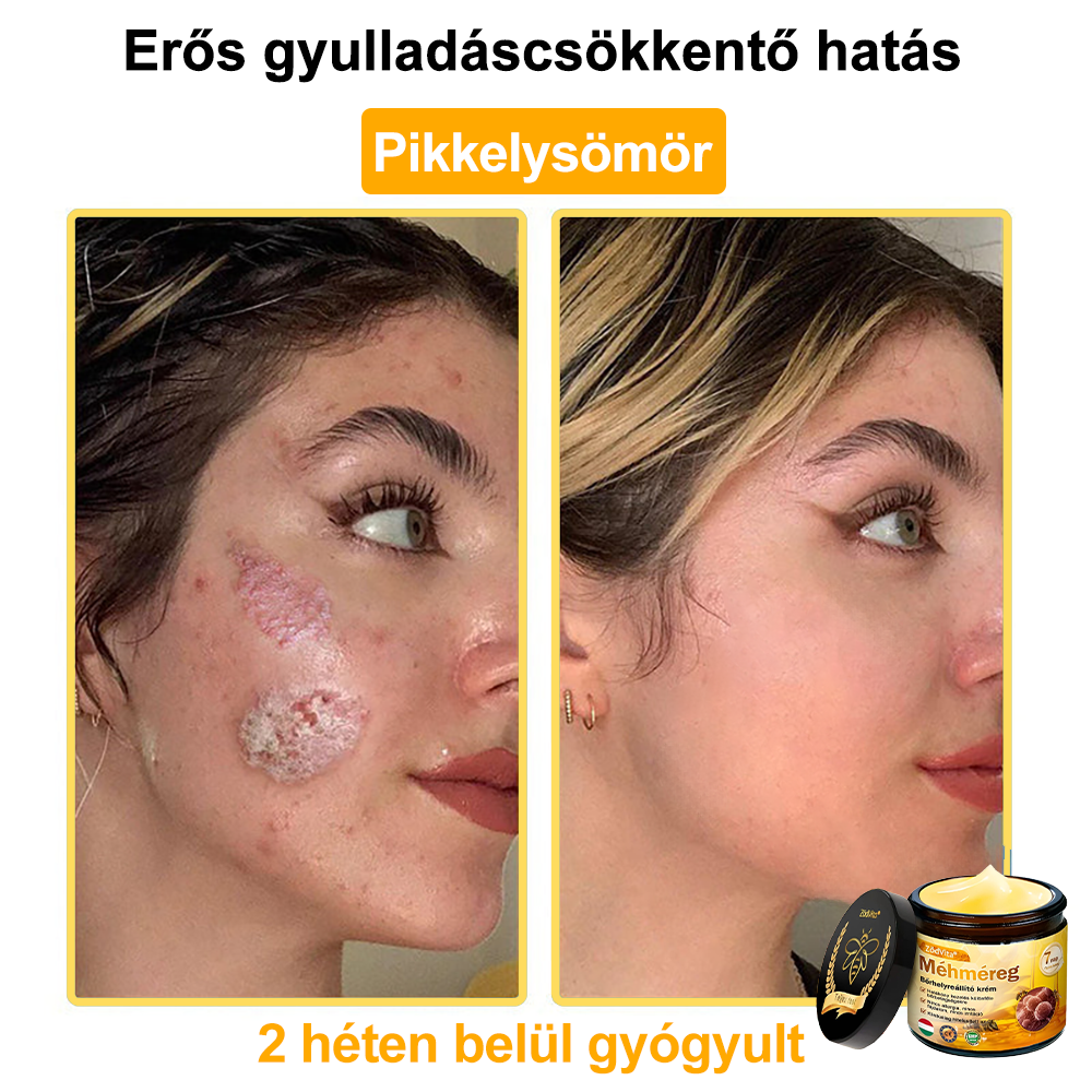🌿Bőrgyógyász ajánlása💪ZödVita® Méhméreg Bőrhelyreállító Krém (👨⚕CE jóváhagyott)✅