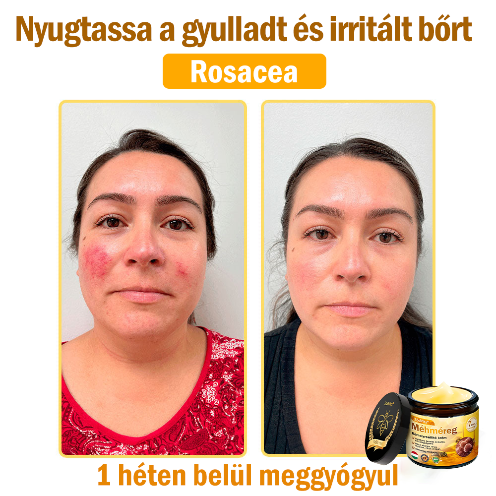 🌿Bőrgyógyász ajánlása💪ZödVita® Méhméreg Bőrhelyreállító Krém (👨⚕CE jóváhagyott)✅
