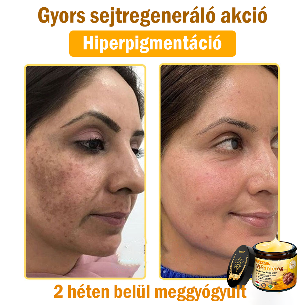 🌿Bőrgyógyász ajánlása💪ZödVita® Méhméreg Bőrhelyreállító Krém (👨⚕CE jóváhagyott)✅