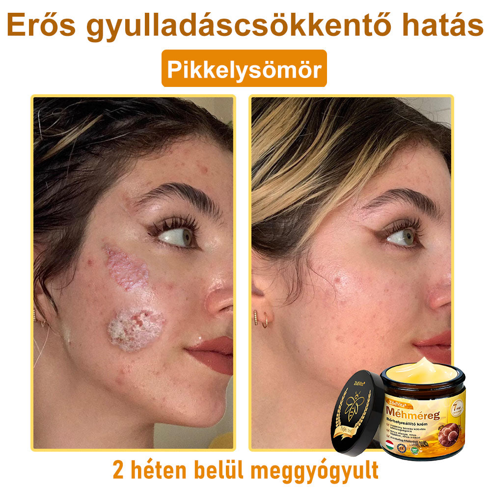 ✨✨Bőrgyógyász ajánlása ✨ ZödVita® Méhméreg Bőr Helyreállító Krém 🔥 Magyar fejlesztés, magyarországi gyártás és szállítás🔥🔥✨