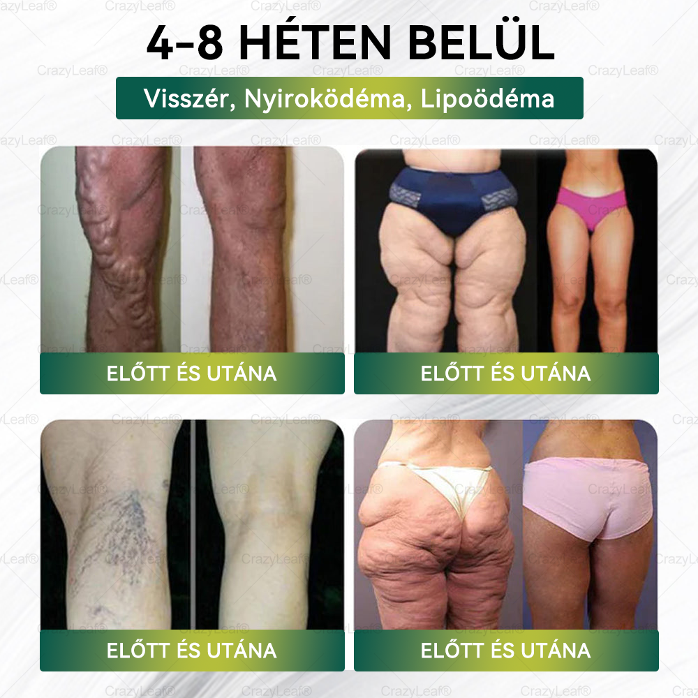 ✨│Hivatalos webáruház│ CrazyLeaf® SMGT-GLP-1 Nano Mikrotűs Tapasz 👉Természetes segítség túlsúly, fáradtság, bőr- és ízületi problémák ellen.ermészetes segítség túlsúly, fáradtság, bőr- és ízületi problémák ellen.🌿