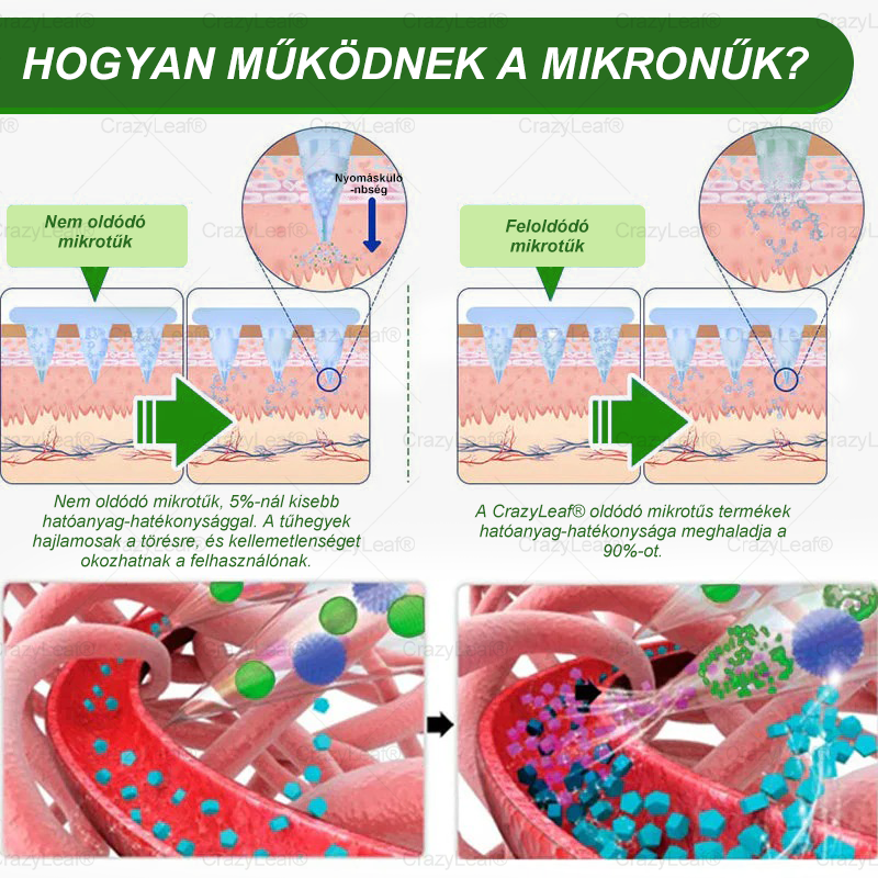 ✨│Hivatalos webáruház│ CrazyLeaf® SMGT-GLP-1 Nano Mikrotűs Tapasz 👉Természetes segítség túlsúly, fáradtság, bőr- és ízületi problémák ellen.ermészetes segítség túlsúly, fáradtság, bőr- és ízületi problémák ellen.🌿