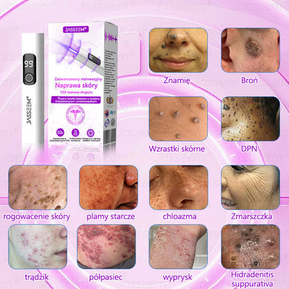 𝐉𝐚𝐬𝐬𝐞𝐞𝐦® Zaawansowany nieinwazyjny laser CO₂ do naprawy skóry 🎉 (Delikatnie usuwa brodawki, znamiona, plamy starcze i narośla skórne – bez bólu, bez zamieszania!)