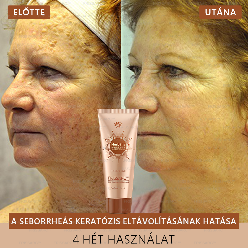 𝐅𝐑𝐈𝐒𝐒𝐀𝐑𝐂™ Fehérítő És Folteltávolító Arcmaszk | Természetes összetevők tartósan eltüntetik a foltokat, szeplőket és napfoltokat